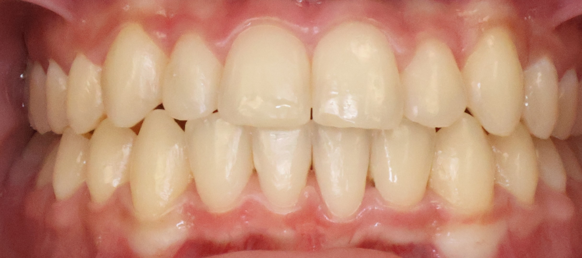 Intraoral after braces — perfect alignment achieved — Berger Orthodontics Anaheim