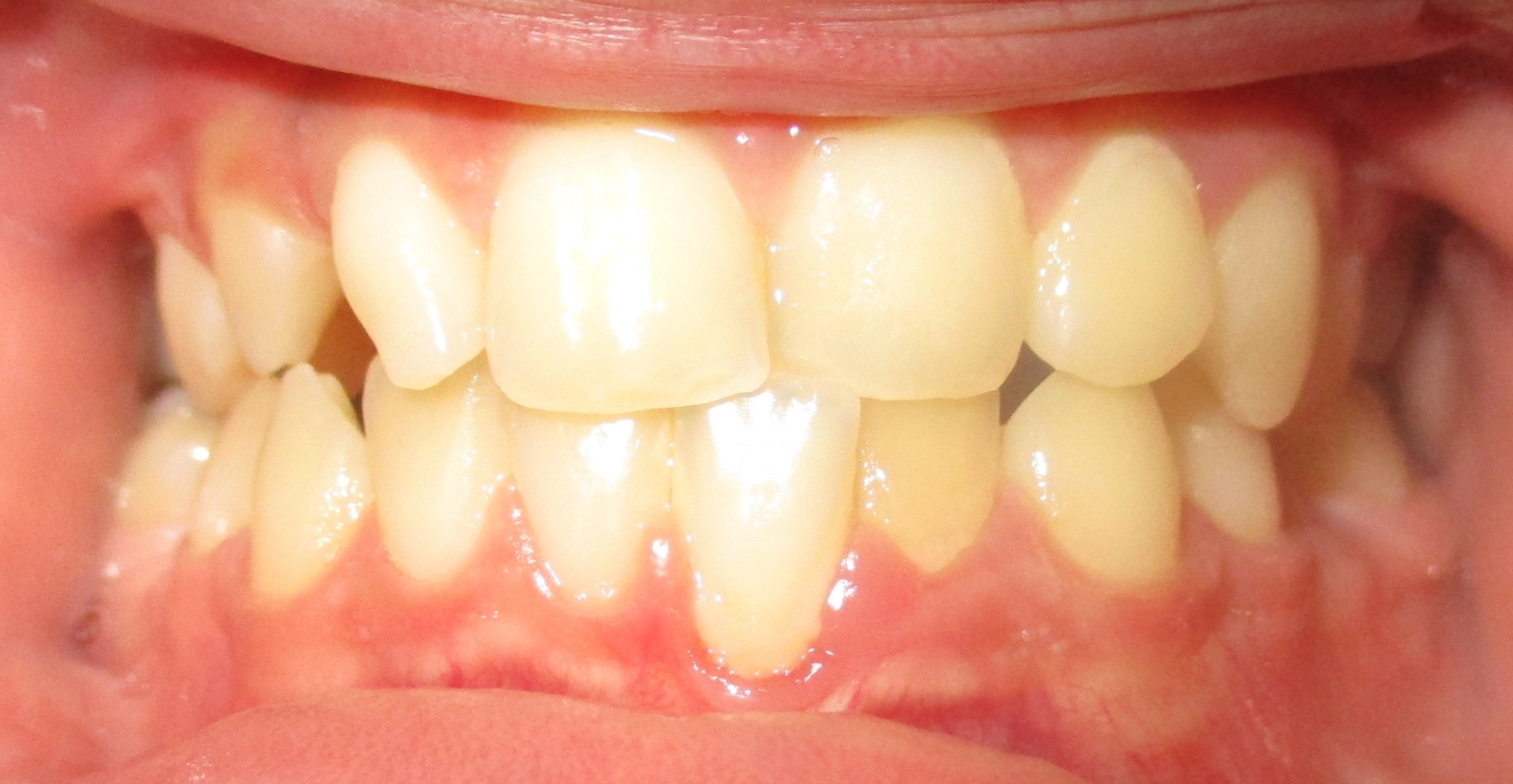 Intraoral before braces — severe crowding and underbite visible — Berger Orthodontics Anaheim