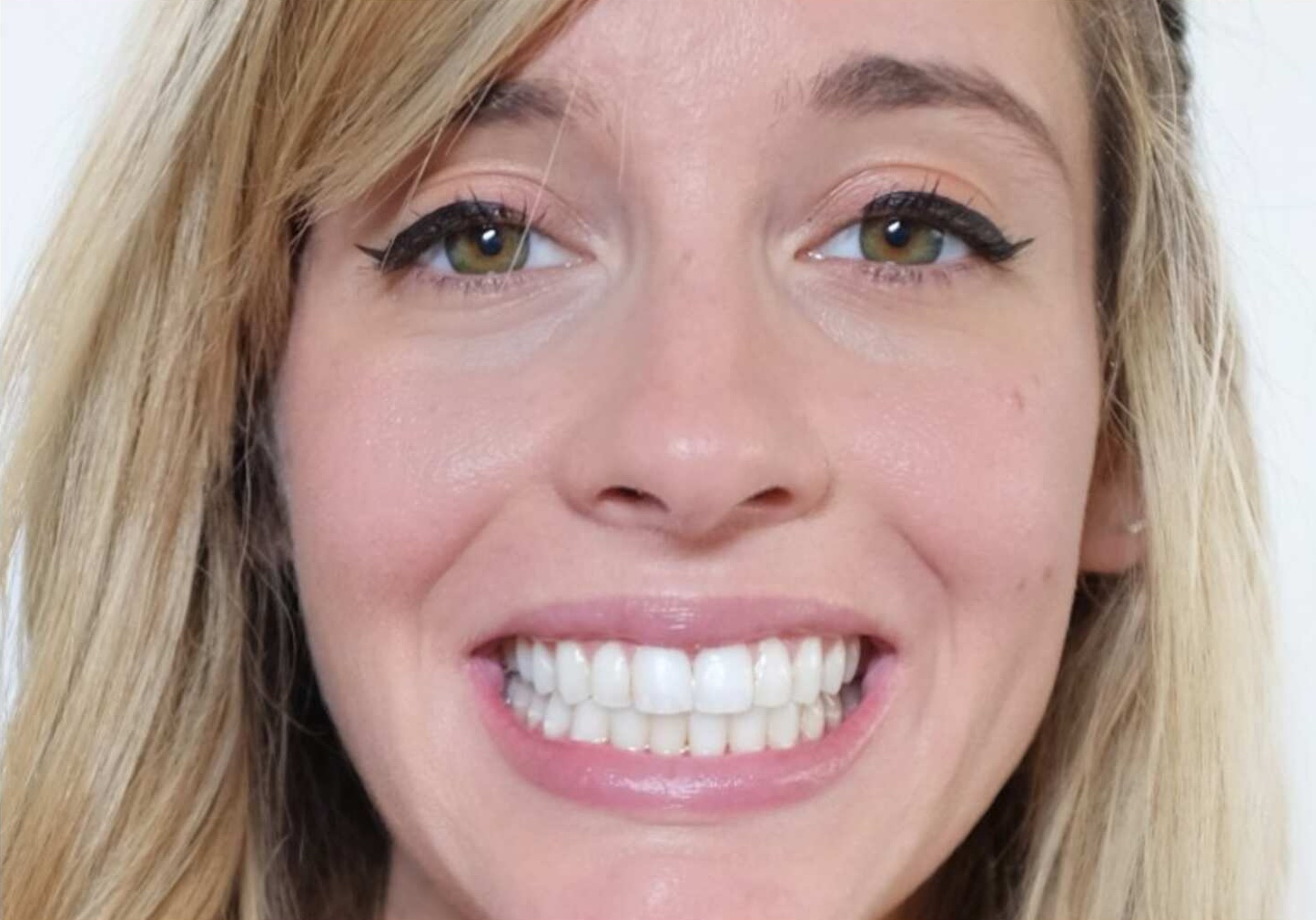 Adult female patient after Invisalign — crowding corrected, full beautiful smile — Berger Orthodontics Anaheim