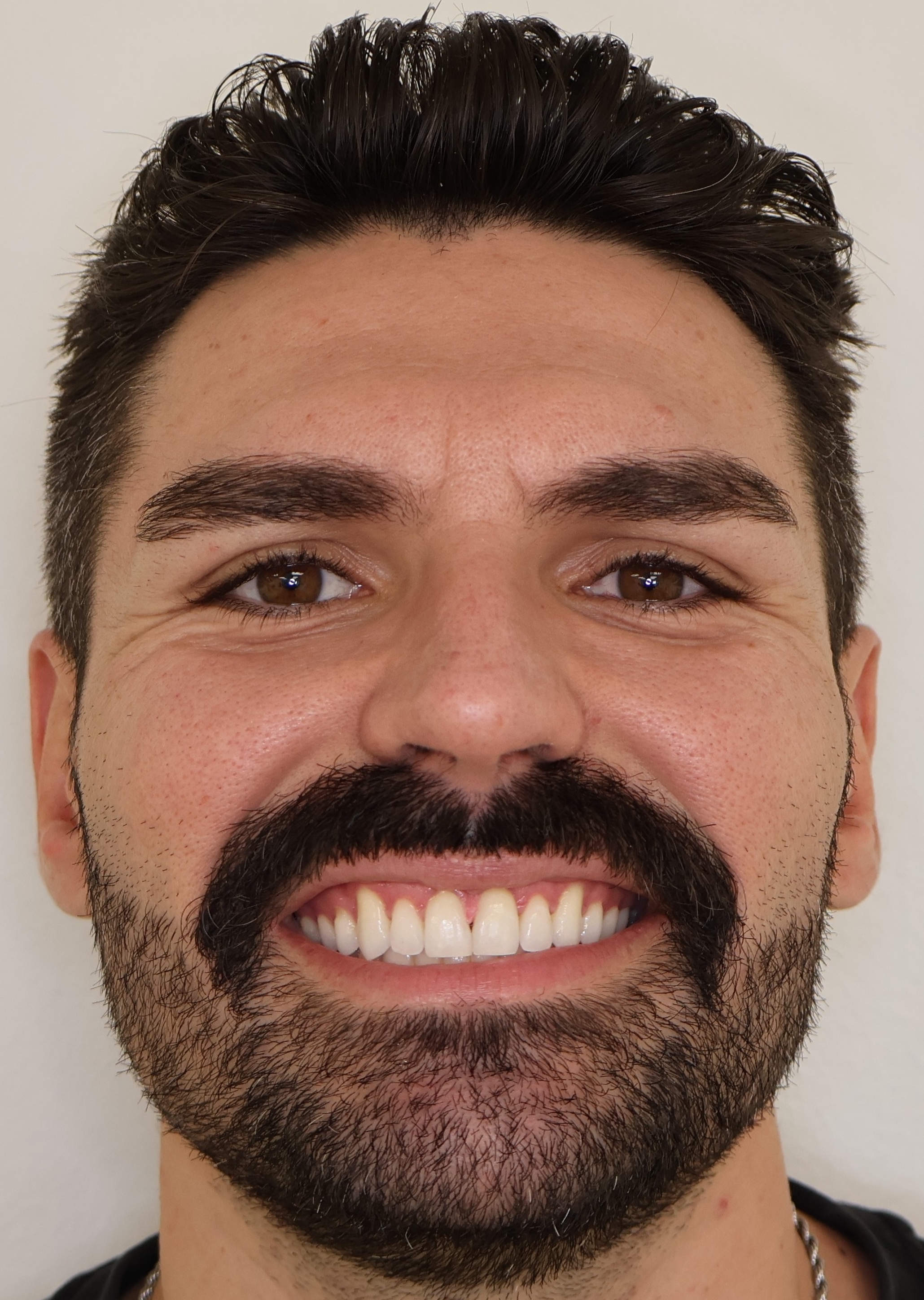 Adult patient after Invisalign diastema closure — gap closed, beautiful smile — Berger Orthodontics Anaheim