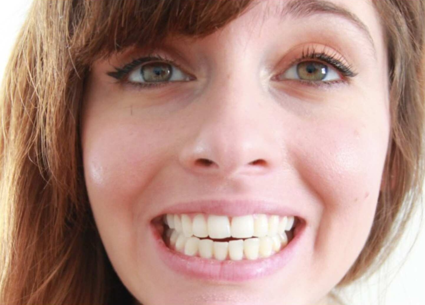 Adult female patient before Invisalign showing crowding — Berger Orthodontics Anaheim