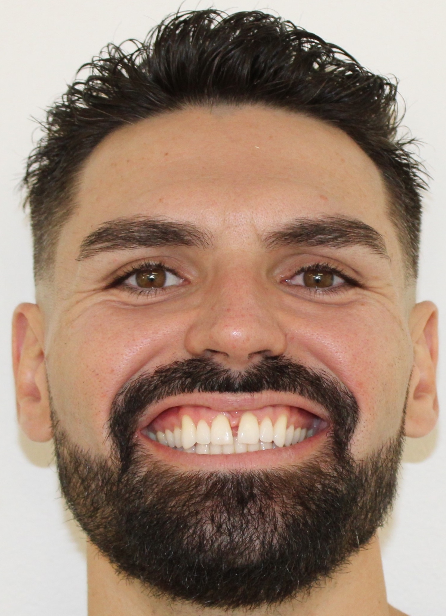 Adult patient before Invisalign showing diastema gap — Berger Orthodontics Anaheim
