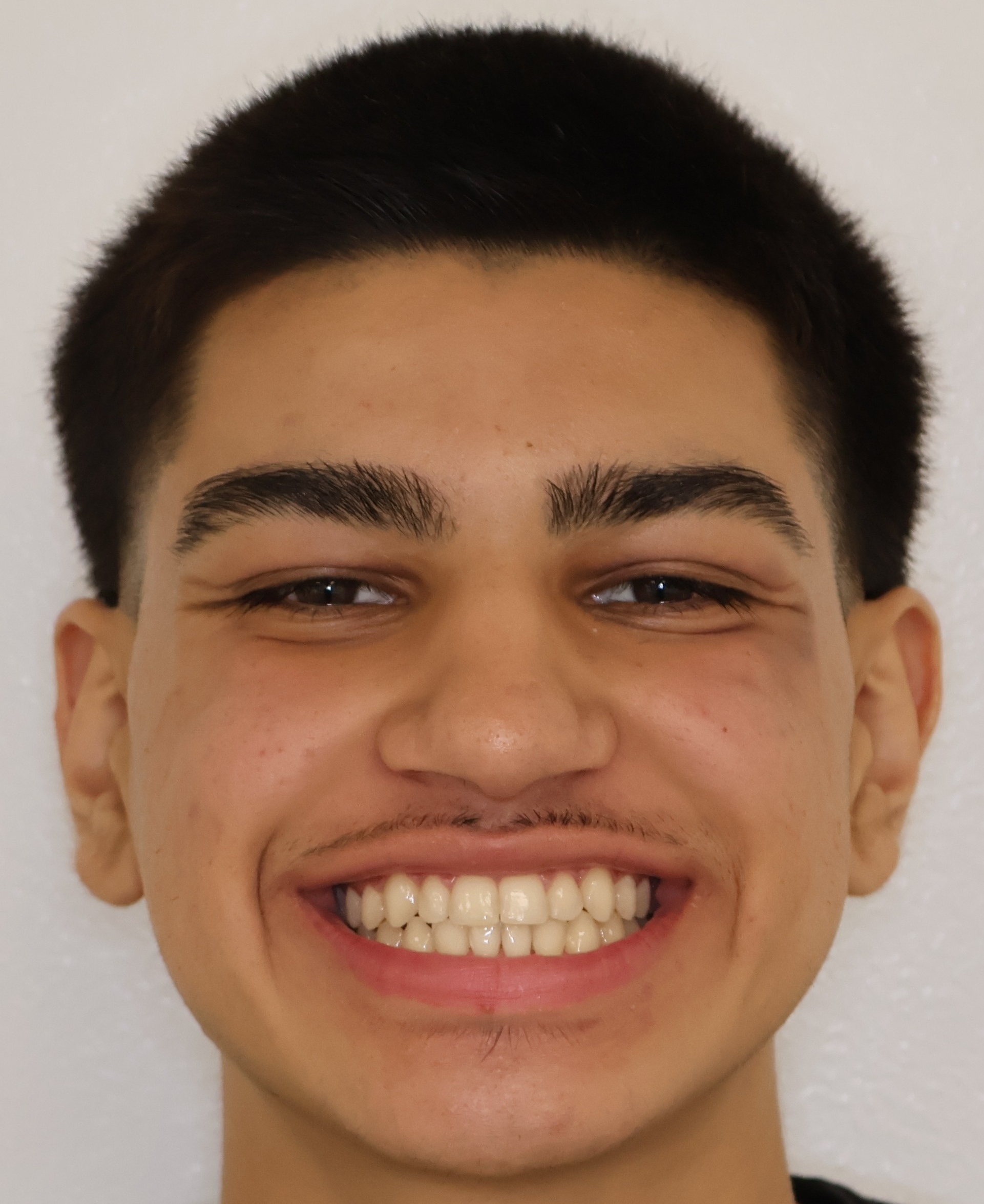 Teen patient after braces — underbite corrected, beautiful smile — Berger Orthodontics Anaheim