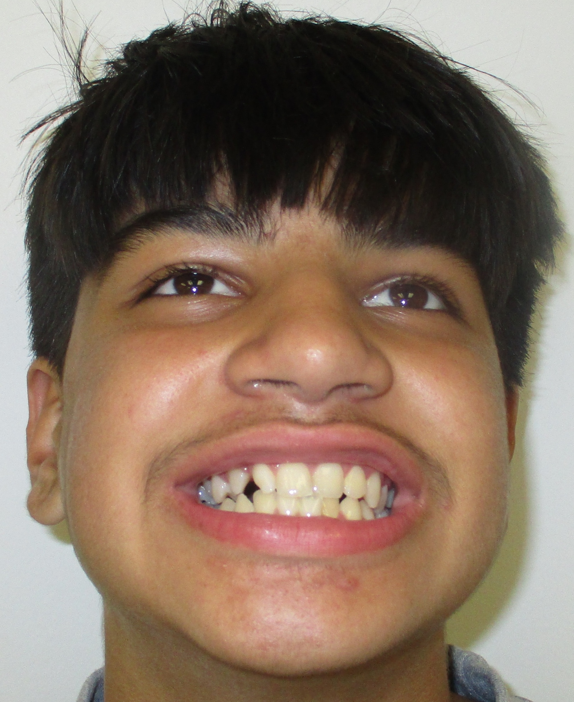 Teen patient before braces — underbite and severe crowding — Berger Orthodontics Anaheim